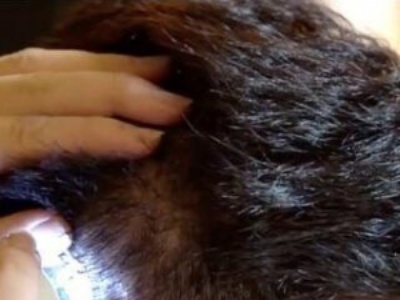 头皮上很多黑头粉刺怎么办 即学头皮清洁2大方法