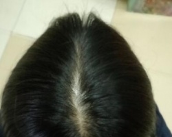 改善脱发的方法有哪些 按摩头皮2个月开始减少脱发