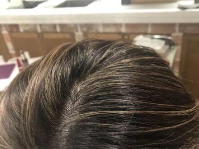 压力大脱发还是季节性脱发？解析常见掉发类型